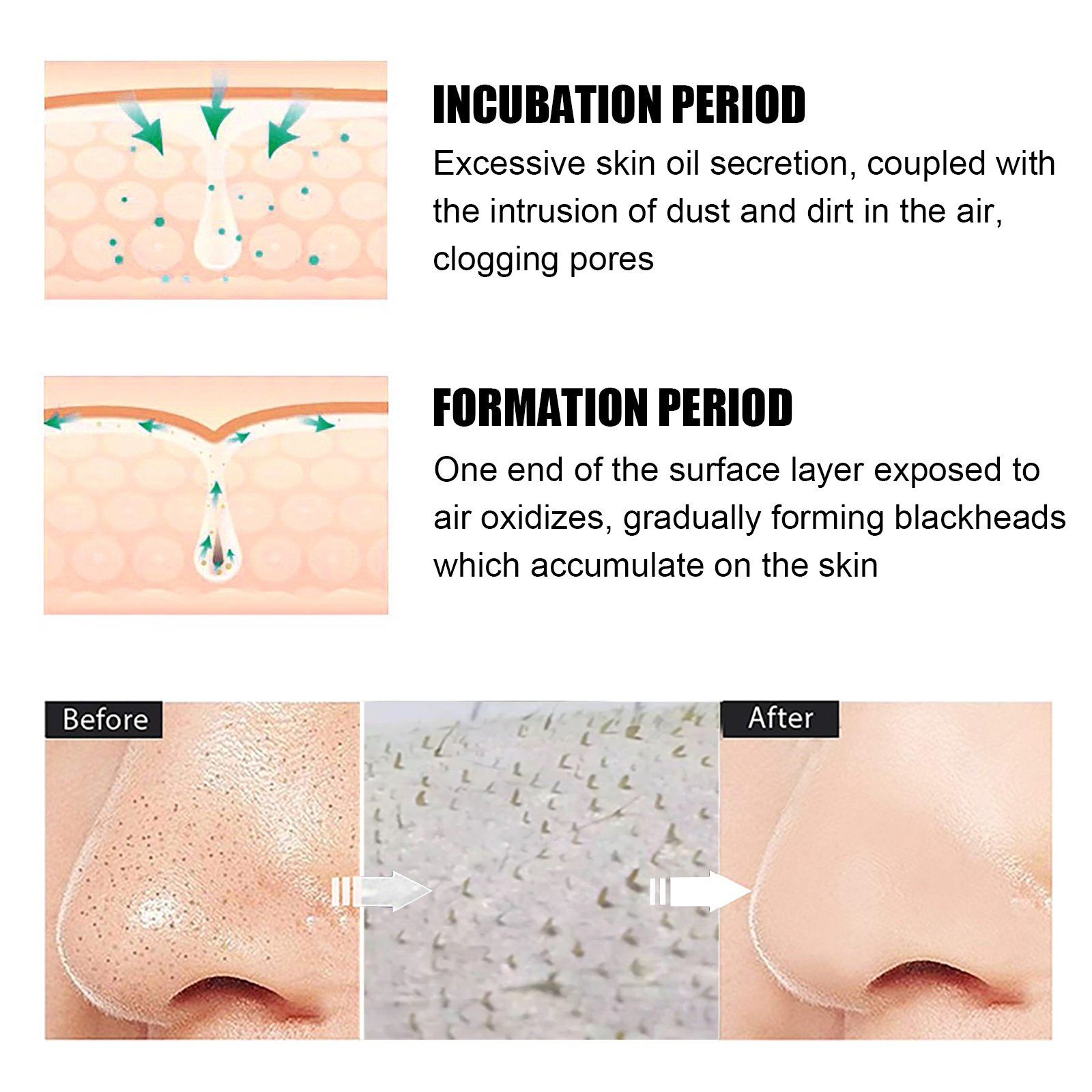 Blackhead Remover Tools -15g Blackhead Creamwith 40Pcs Blackhead Pore Strips - Image 5